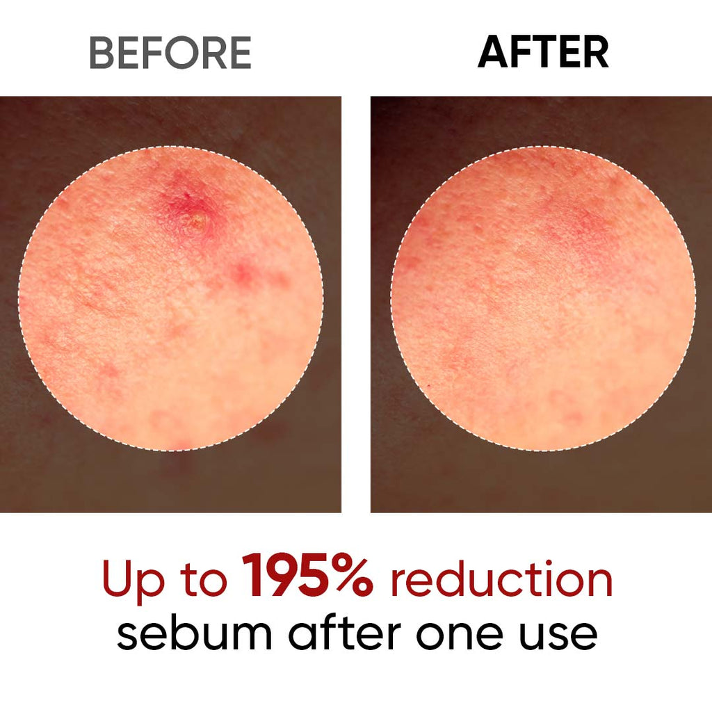 SANUO® Black Rice Еxfoliating Ampoule